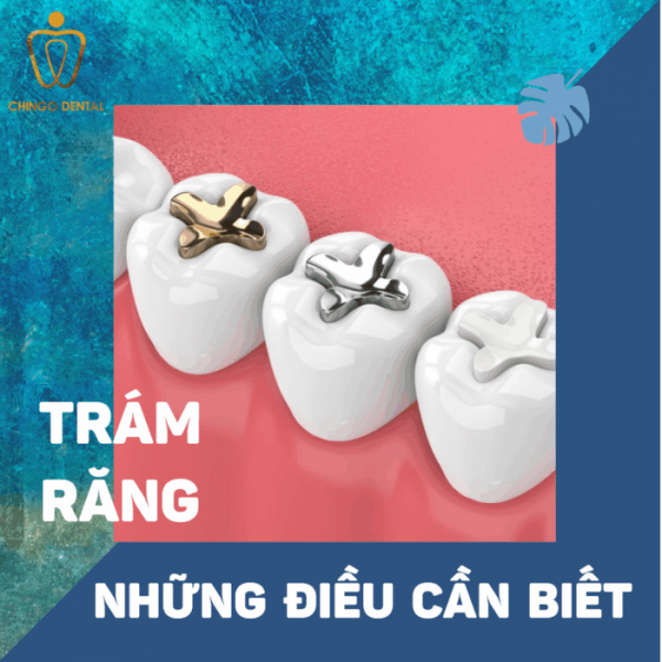 Trám răng và những điều cần biết 21 tram-rang-nhung-dieu-can-biet-ava-3-700x700-chingo-dental