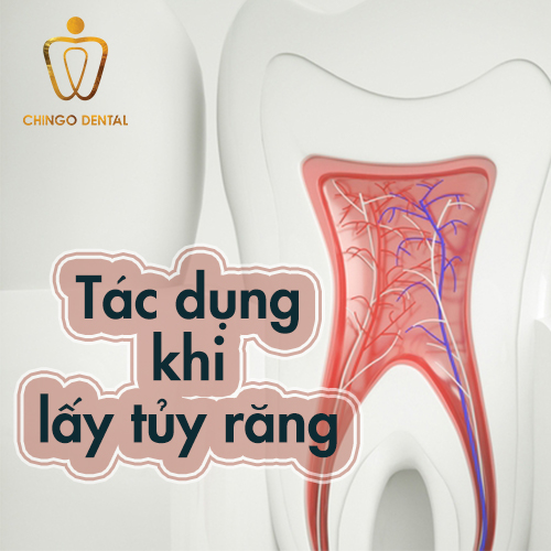 Lấy tủy răng có gây ảnh hưởng gì không? 10 lay-tuy-rang-web-chingo-dental
