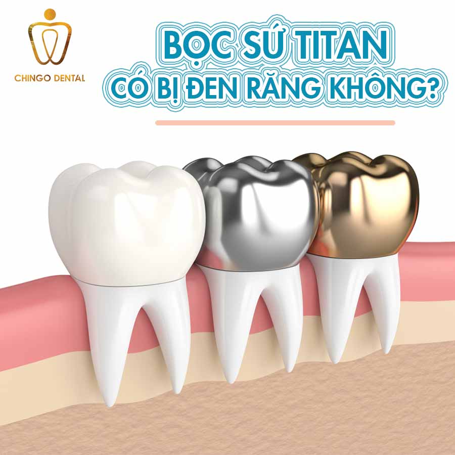 Bọc răng sứ Titan có bị đen không và cách khắc phục như thế nào? 16 boc-su-titan-web