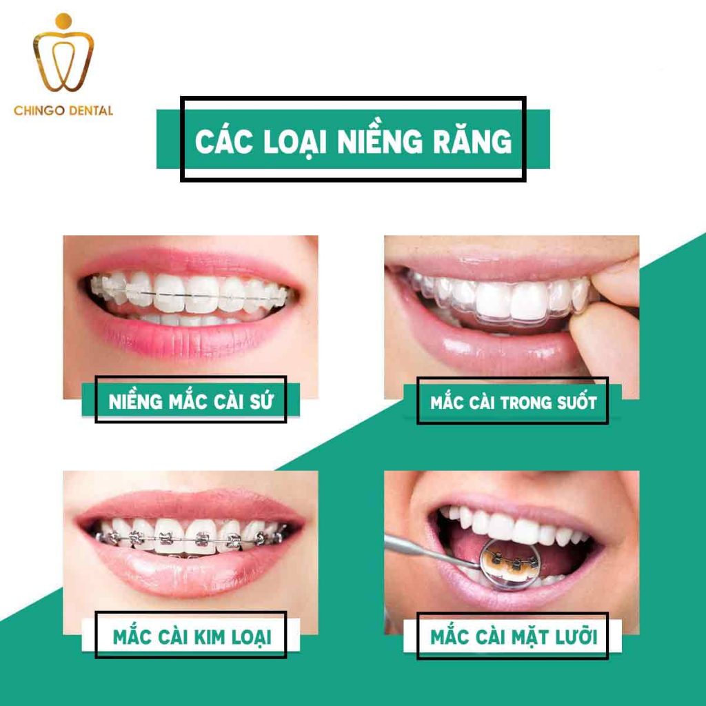 Các phương pháp niềng răng hiện nay 8 cac-loai-nieng-rang-final-chingo