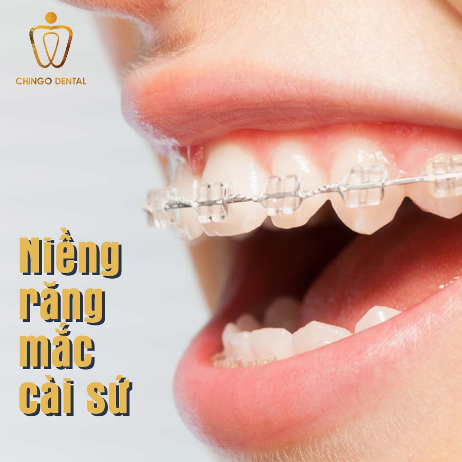 Niềng răng mắc cài sứ có tốt không? 6 nieng-rang-mac-cai-su-web-chingo-dental