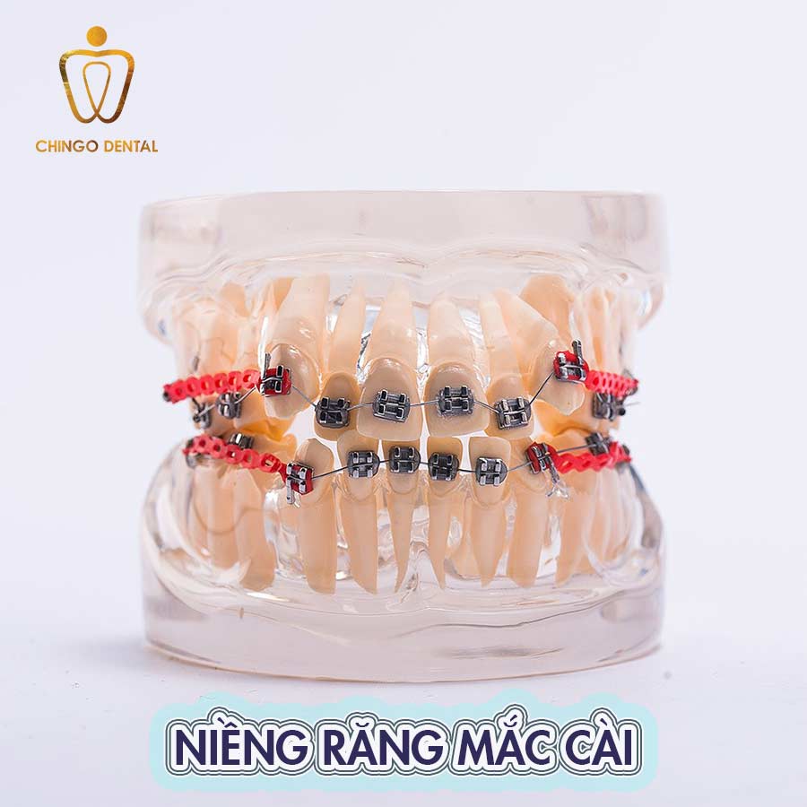 Niềng răng mắc cài – Vĩnh biệt răng thưa, hô, móm, khấp khểnh 4 nieng-rang-mac-cai-web-chingo-dental