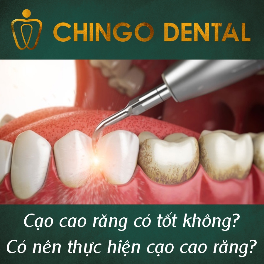 Cạo cao răng có tốt không? Có nên thực hiện cạo cao răng? 2 Cao Cao Rang Chingo Dental