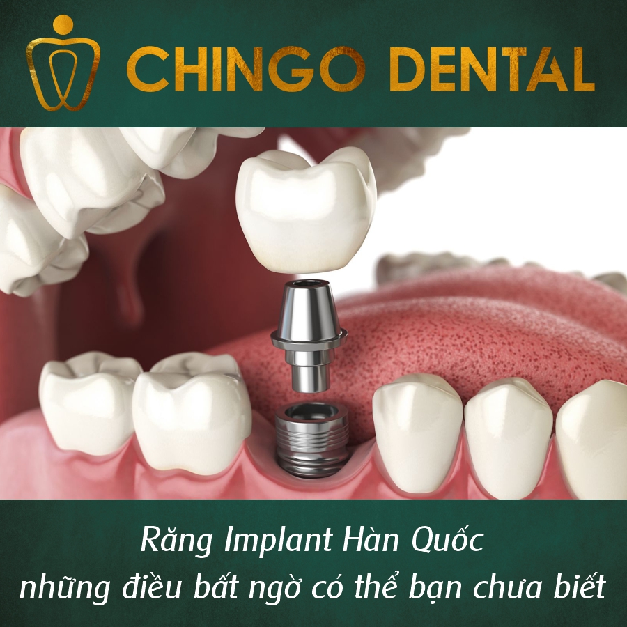 Răng Implant Hàn Quốc – Những điều bất ngờ có thể bạn chưa biết 1 Rang Implant Han Quoc Chingo Dental