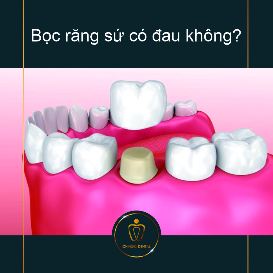 Bọc răng sứ có đau không? 2 Boc Rang Su Co Dau Khong Chingo Dental