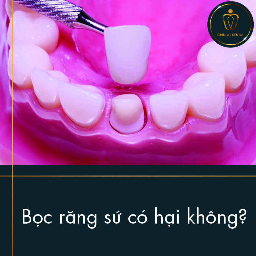 Bọc răng sứ có hại không? 1 Boc Rang Su Co Hai Khong Chingo Dental