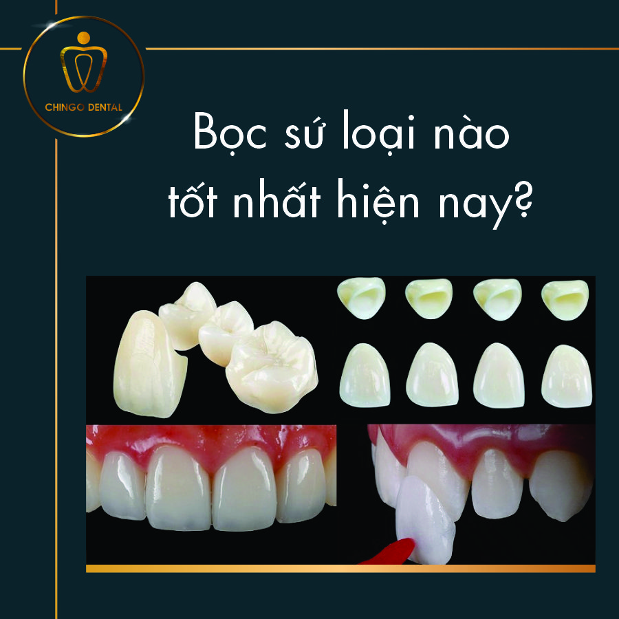Bọc Răng Sứ Loại Nào Tốt Nhất? Kinh Nghiệm Chọn Loại Răng Và Địa Chỉ Uy Tín 4 Boc Rang Su Loai Nao Tot Nhat Hien Nay Chingo Dental