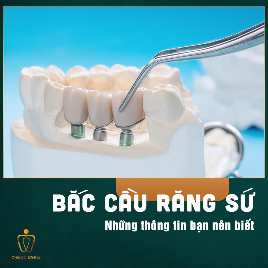 Làm cầu răng sứ – những thông tin mà bạn nên biết 9 Lam Cau Rang Su Chingo Dental