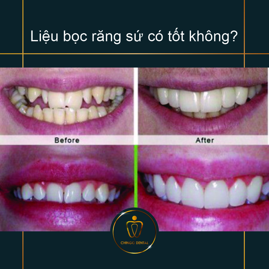 Liệu bọc răng sứ có tốt không? 3 Lieu Boc Rang Su Co Tot Khong Chingo Dental