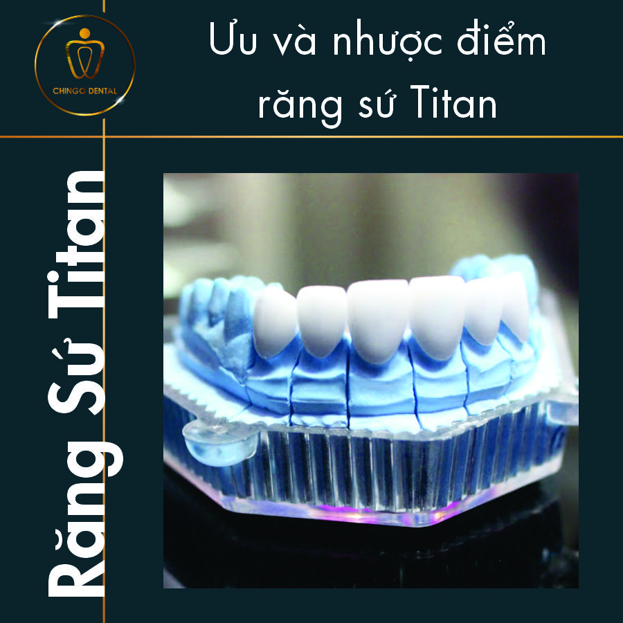 Răng sứ Titan là gì? Ưu và nhược điểm của răng sứ Titan 8 Rang Su Titan Chingo Dental