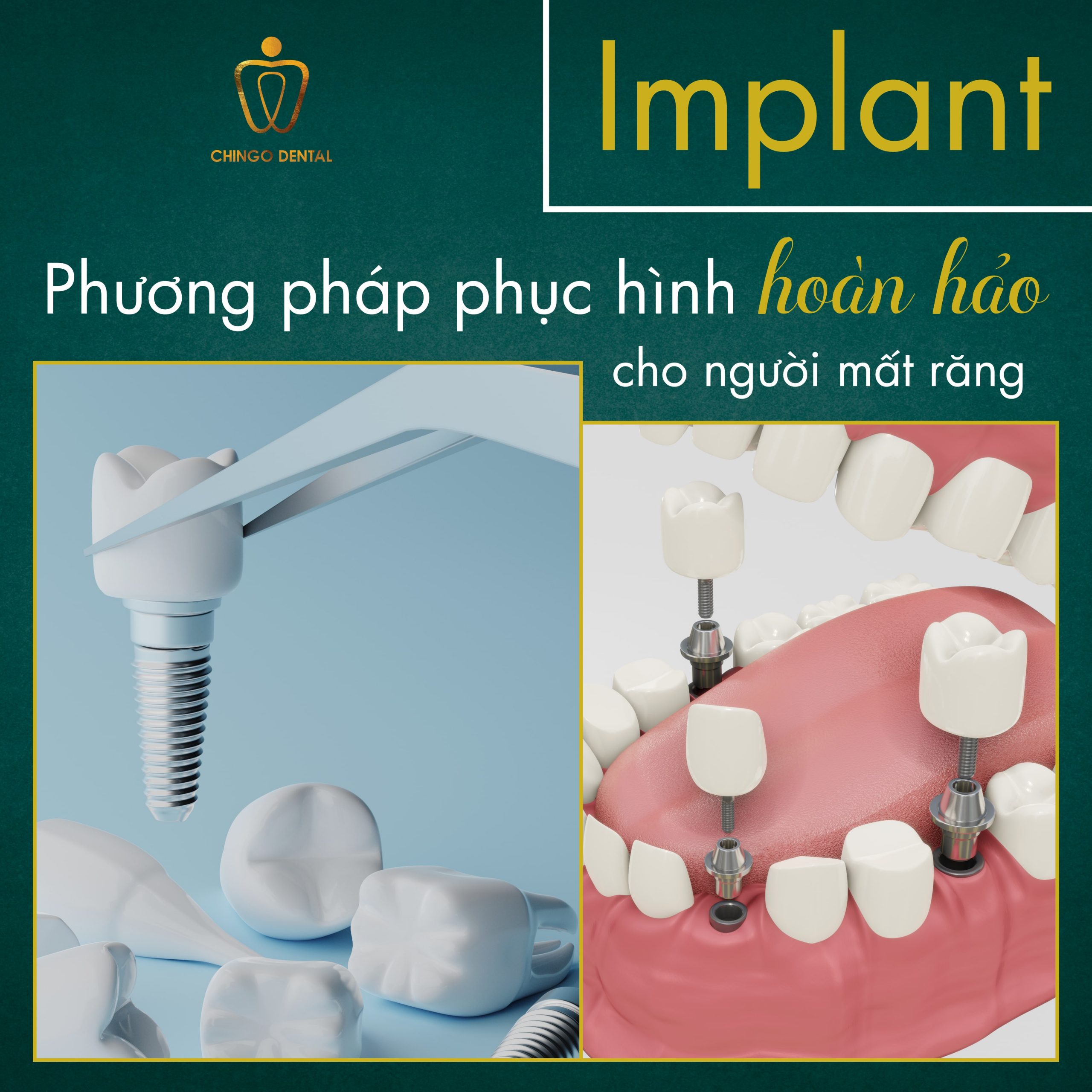 210427-Dental-Implant-Chingo-Min