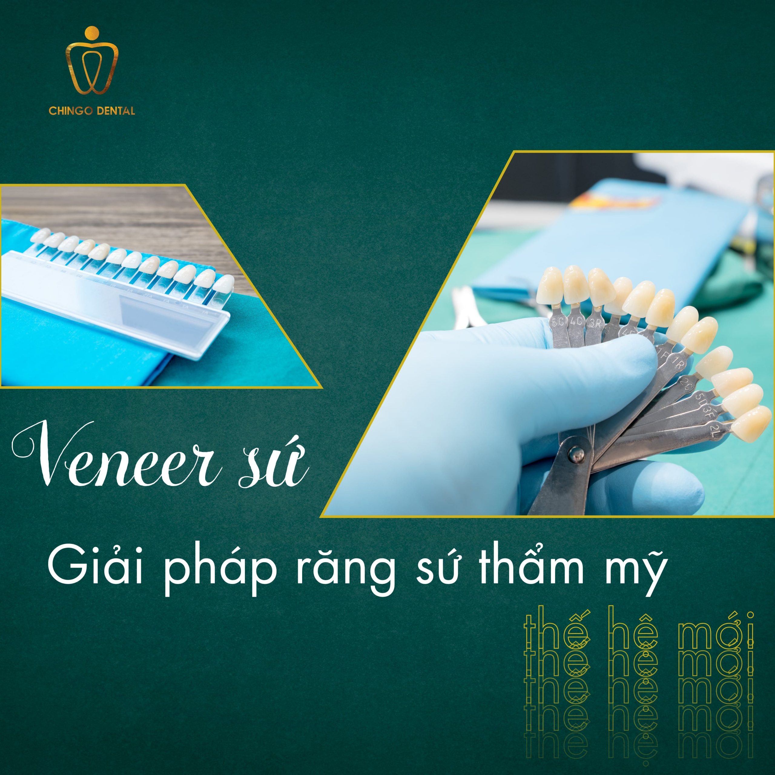 210427-Dental-Veneer-Chingo-Min