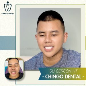 021220 Nguyen Viet Hung 20cercon Min