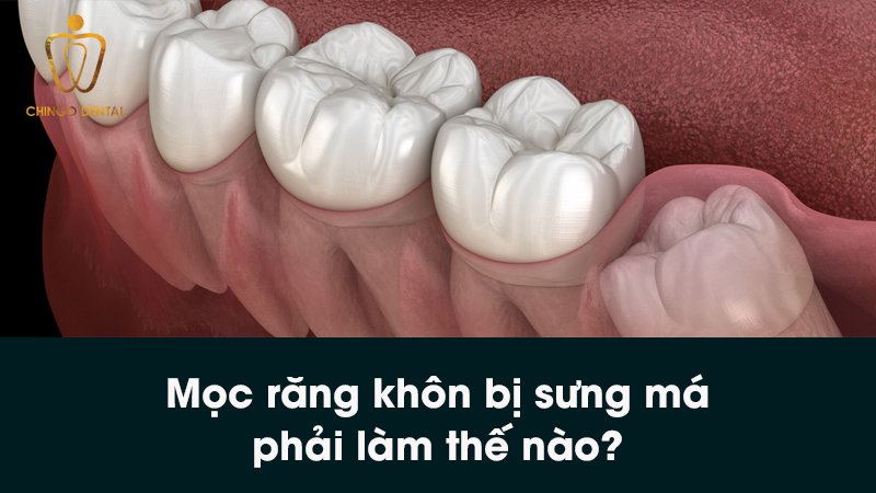 moc rang bi sung ma chingo dental 1