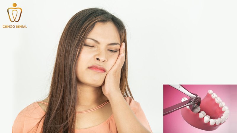 moc rang khon bi sung ma chingo dental 2