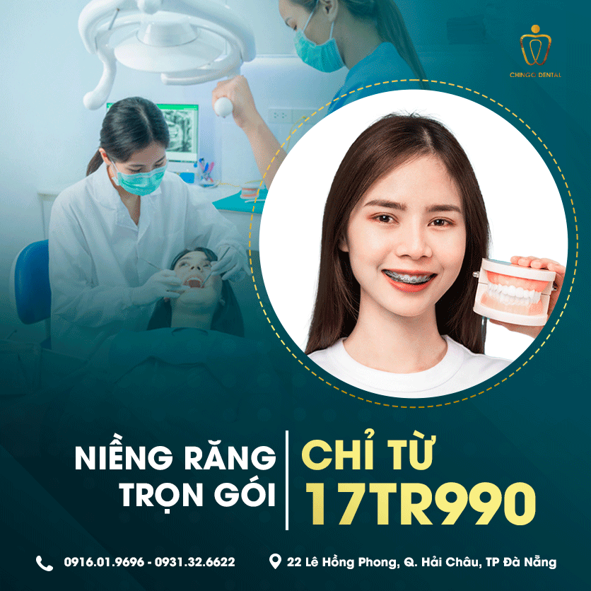 Niềng Răng Là Gì? Chi Phí Và Những Câu Hỏi Thường Gặp Về Niềng Răng 2 nieng rang mb