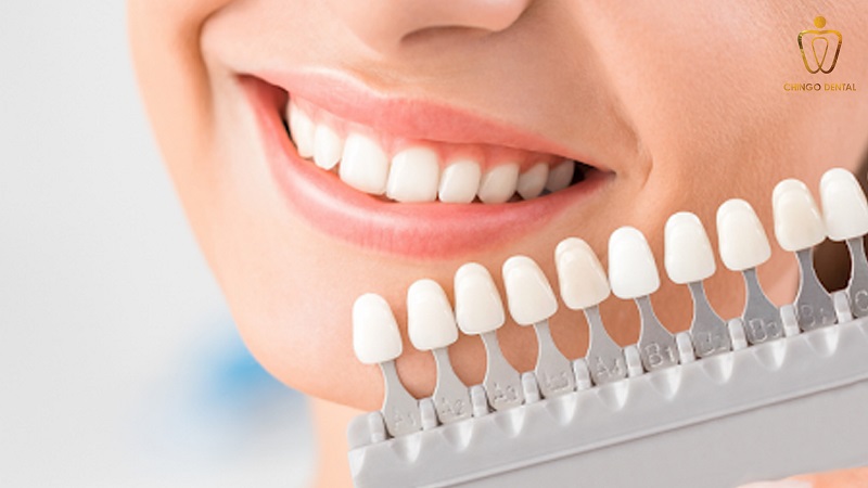 rang-su-cercon-gia-bao-nhieu