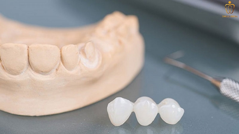 bọc răng sứ nguyên hàm giá bao nhiêu