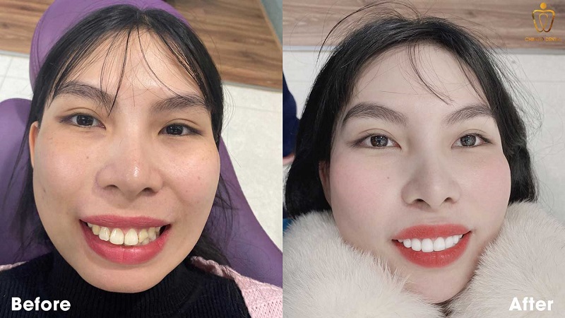 KH-lam-boc-rang-su-nguyen-ham