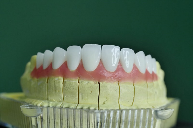 rang-su-tham-my-nha-khoa-chingo