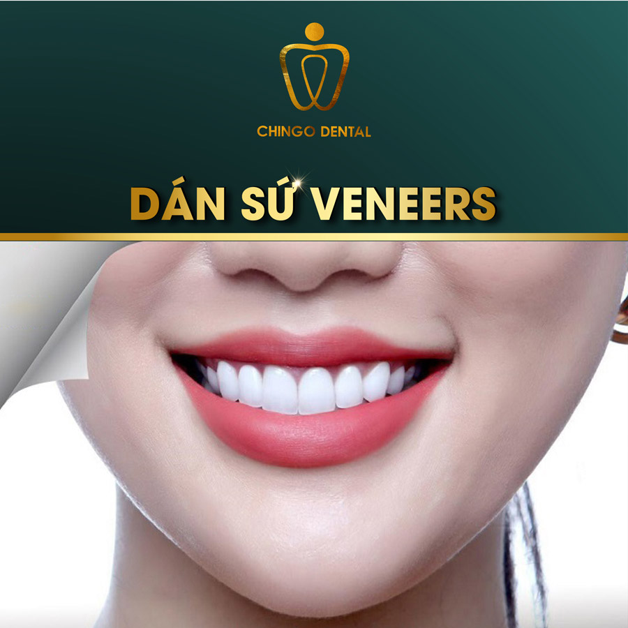 Chingo Dental Dán sứ Veneer
