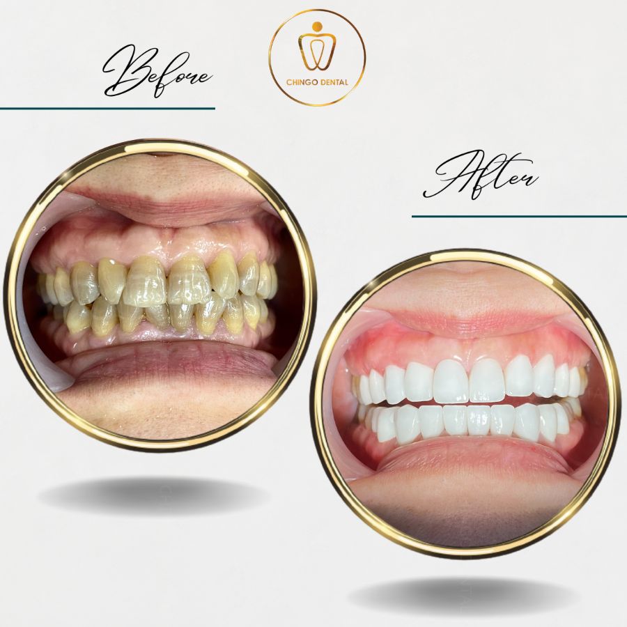 boc rang su khac phuc khiem khuyet