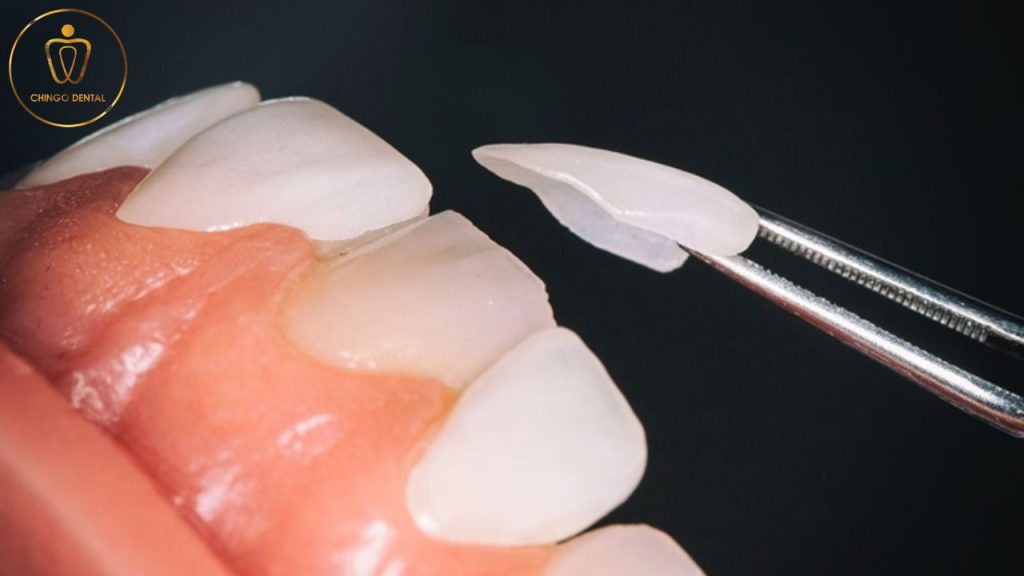 dan su veneer chingo