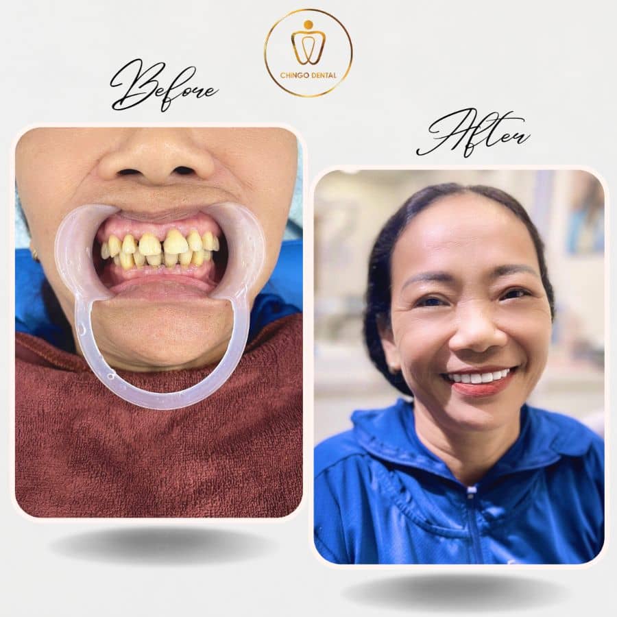 rang ho khac phuc nho boc su