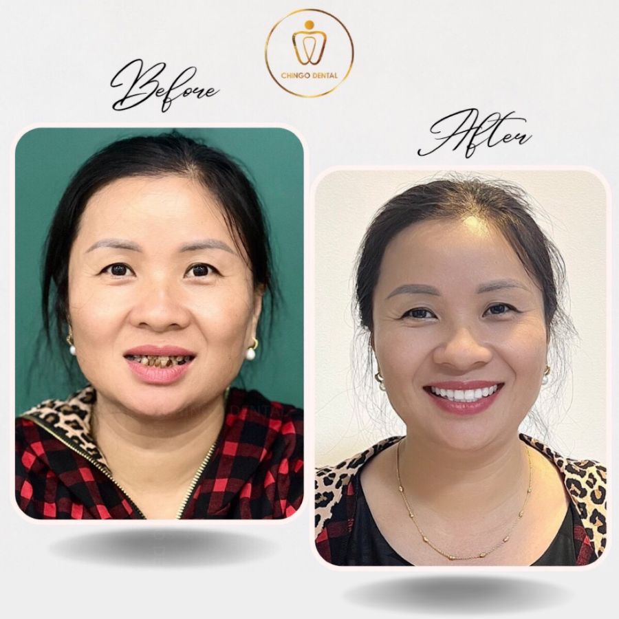 truoc sau boc rang su tai chingo 1