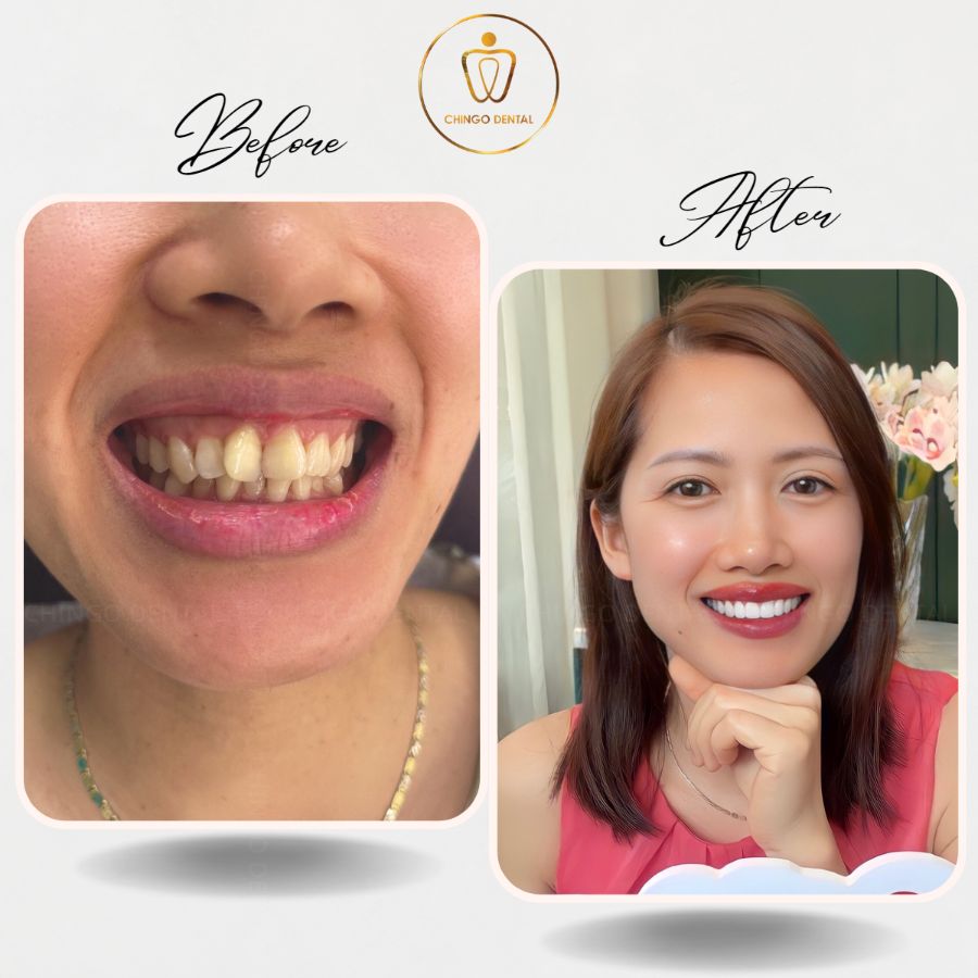 truoc sau boc rang su tai chingo 2