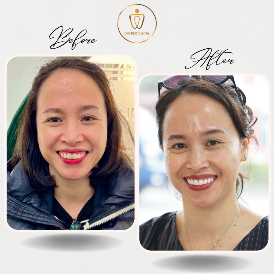 truoc sau boc rang su tai chingo 3