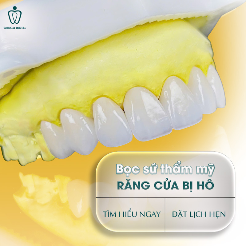 bọc răng sứ 2 răng cửa bị hô