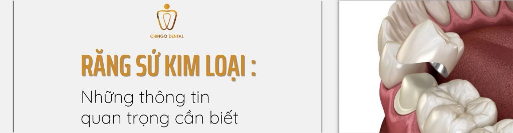 Răng Sứ Kim Loại Là Gì? 3 Loại Phổ Biến & Cách Chăm Sóc Bền Lâu 6 Cap Nhat Thong Tin Ve Rang Su Kim Loai Moi Nhat 2023