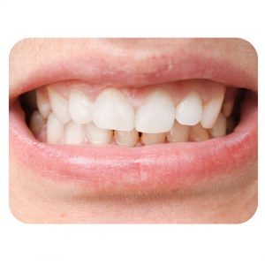 Cau-truc-ham-bi-lech