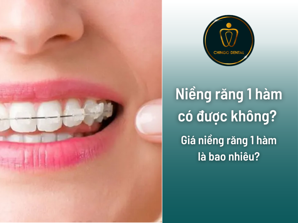 Niềng răng 1 hàm có được không? giá niềng răng 1 hàm là bao nhiêu? 1 Fauget Dentist 1