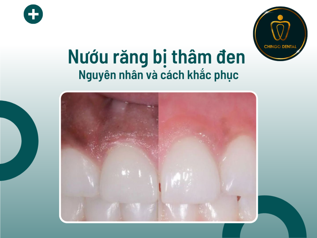 Nướu răng bị thâm đen: Nguyên nhân và cách khắc phục 8 Fauget Dentist