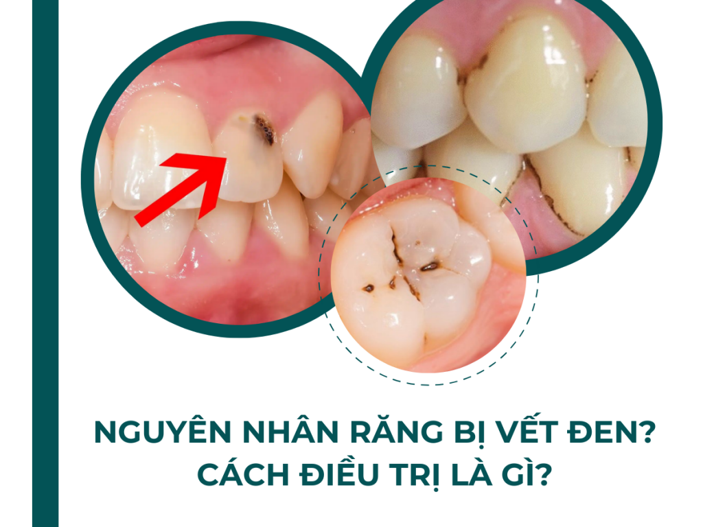 NGUYÊN NHÂN TẠI SAO RĂNG BỊ VẾT ĐEN? CÁCH ĐIỀU TRỊ LÀ GÌ? 14 NGUYEN NH N TAI SAO RANG BI VET DEN CACH DIEU TRI LA GI