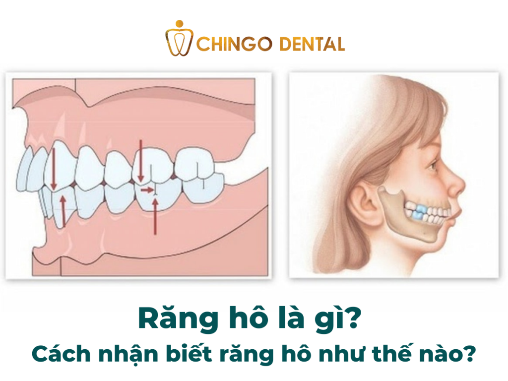 Răng hô là gì? Cách nhận biết răng hô như thế nào? 36 Rang ho la gicach nhan biet rang ho