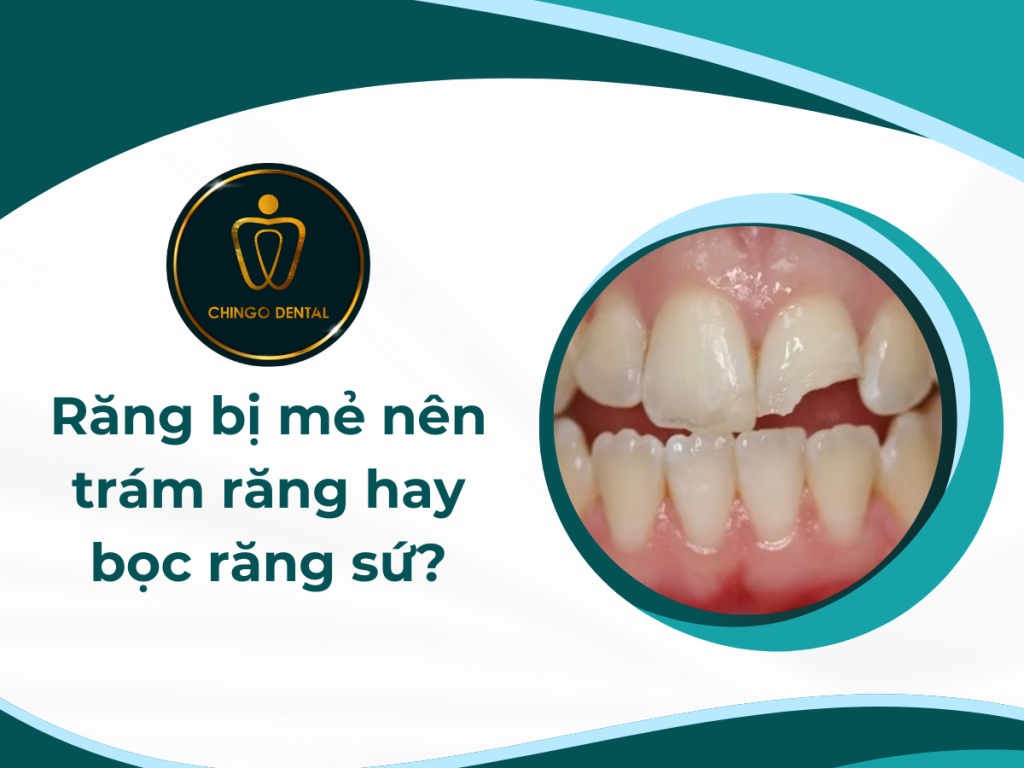 Răng bị mẻ nên trám răng hay bọc răng sứ? 1 1 1