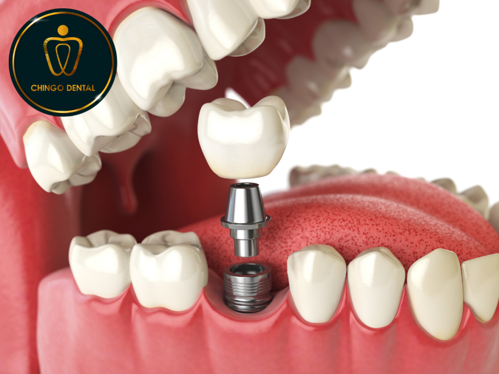 5 LÝ DO NÊN TRỒNG RĂNG IMPLANT 45 5 LY DO NEN TRONG RANG IMPLANT