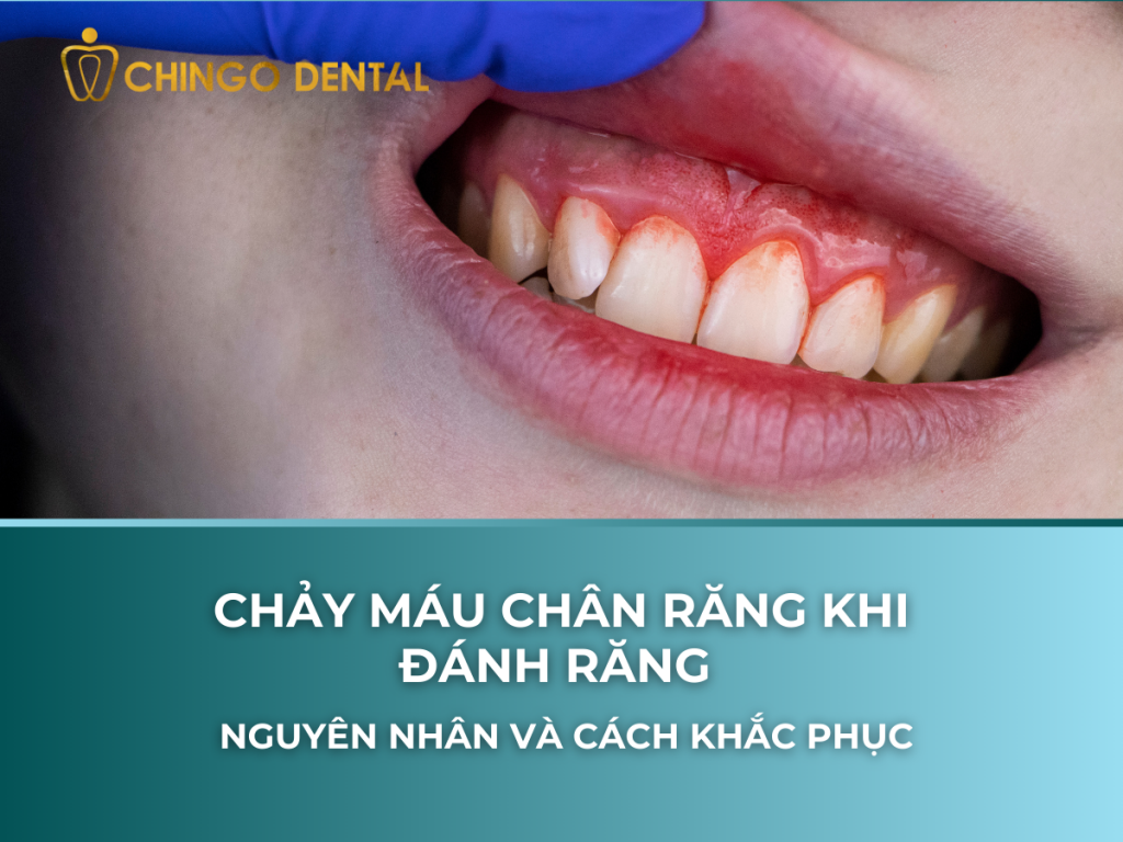 CHAY MAU CHAN RANG KHI DANH RANG NGUYEN NHAN VA CACH KHAC PHUC