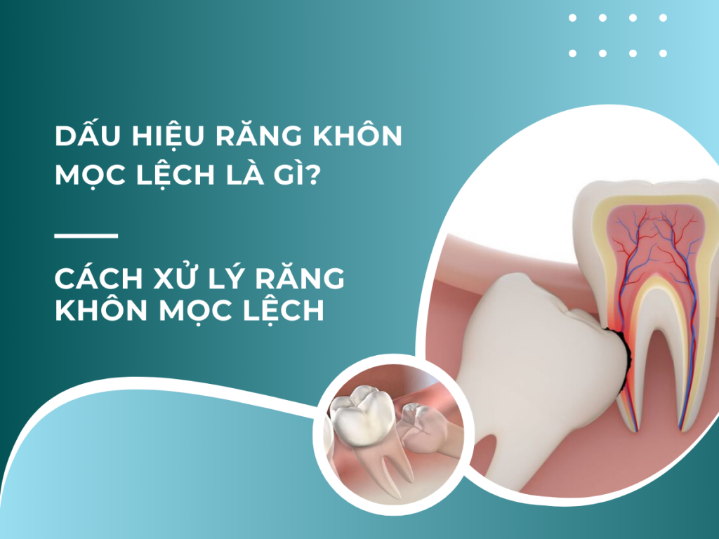 Dấu hiệu răng khôn mọc lệch là gì? Cách xử lý răng khôn mọc lệch 31 Dau hieu rang khon moc lech la gi