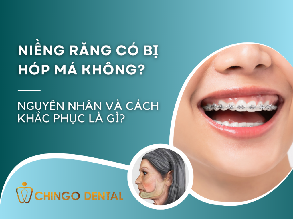 Niềng răng có bị hóp má không? Nguyên nhân và cách khắc phục là gì? 50 Nieng rang co bi hop ma khong Nguyen nhan va cach khac phuc la gi