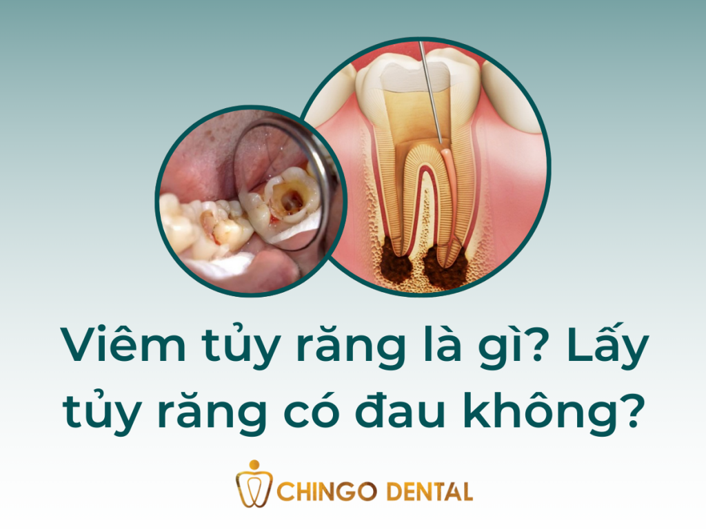 Viem tuy rang la gi Lay tuy rang co dau khong