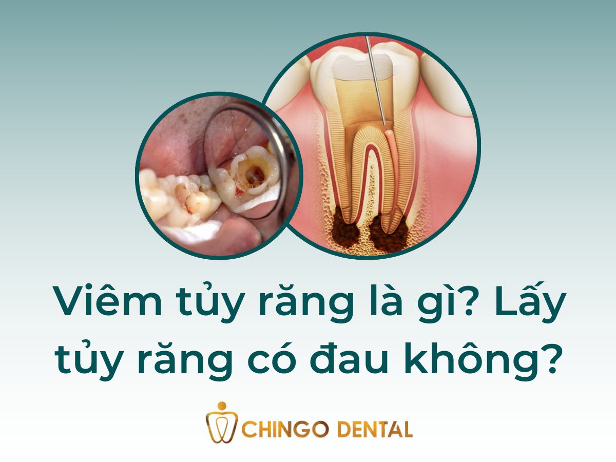Viêm tủy răng là gì_ Lấy tủy răng có đau không