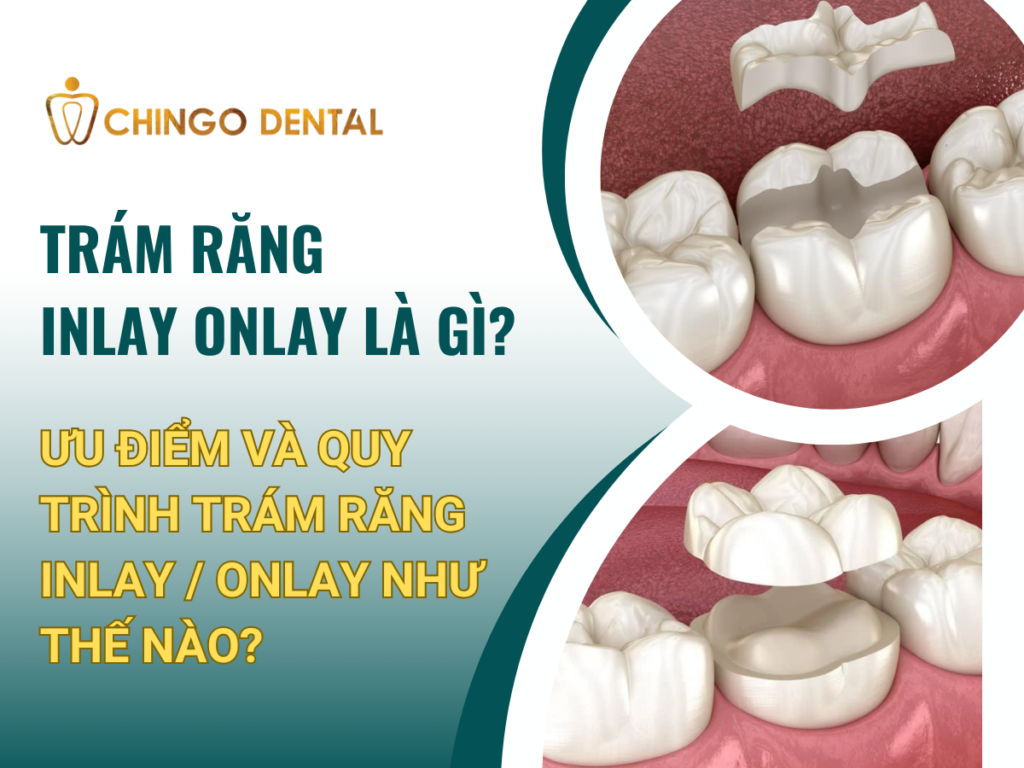 Trám răng inlay onlay là gì? Ưu điểm và quy trình trám răng inlay onlay như thế nào? 24 1