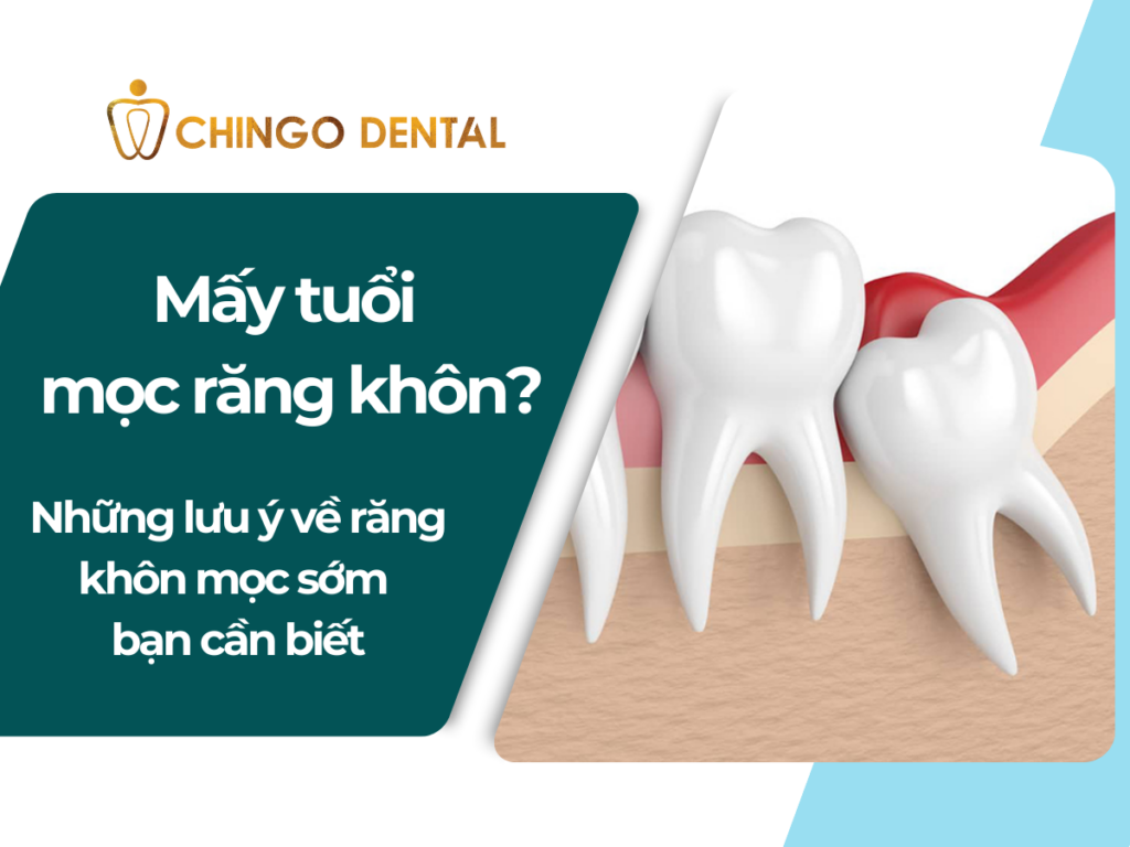 Mấy tuổi mọc răng khôn và những lưu ý cần biết 13 1 2