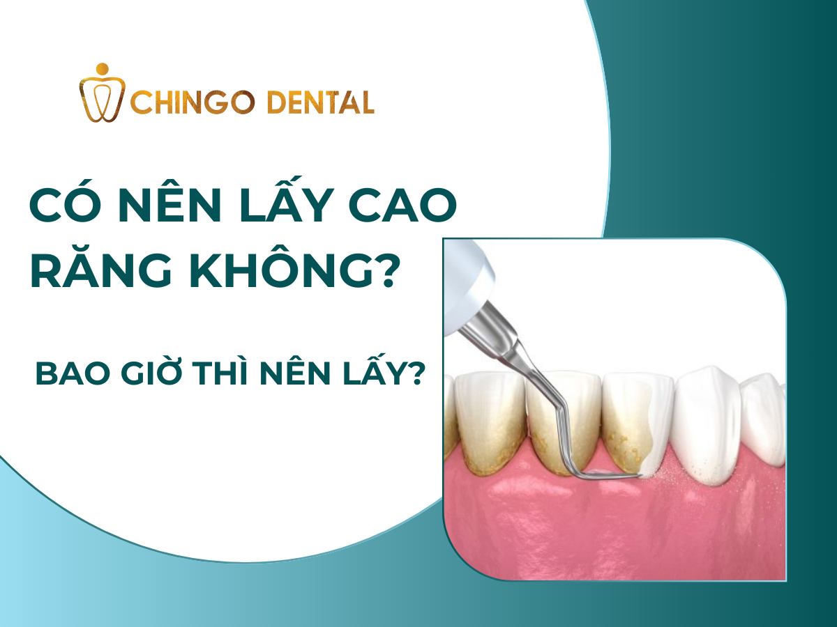 Có nên lấy cao răng không? Bao giờ thì nên lấy? 6