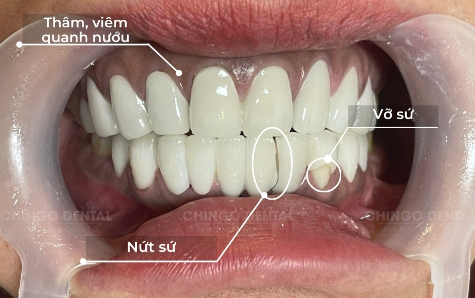 Có thay răng sứ được không? Những ảnh hưởng khi thay răng sứ lỗi 2 sut-me-rang-su-chingo