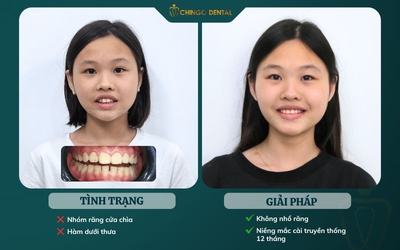 niềng răng hà nội